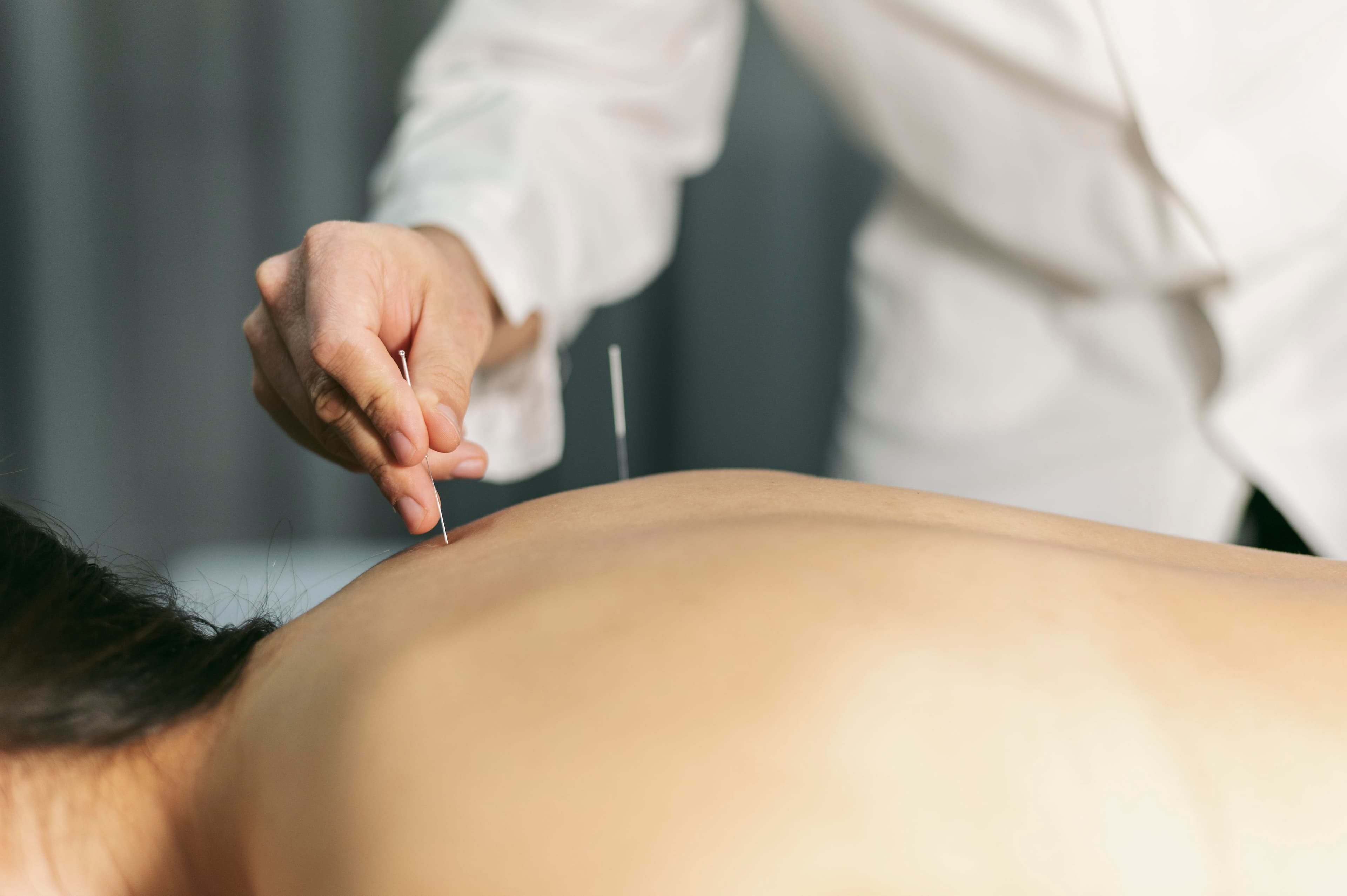 Acupuntura para Ansiedade: como a técnica milenar alivia o estresse moderno